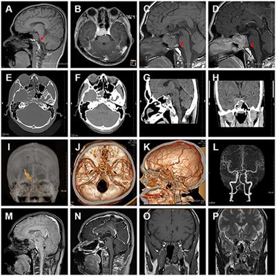 A Large Cavernous Sinus Giant Cell Tumor Invading Clivus and Sphenoid Sinus Masquerading as Meningioma: A Case Report and Literature Review